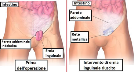 ERNIA INGUINALE, OMBELICALE, CRURALE  New Life - Centro Medico  Polispecialistico e Chirurgico